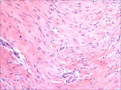 Fibromatoses!

*Histology: cell of origin is myofibroblast
-Plump cells, broad sweeping fascicles
-Penetrate adjacent tissue
-Infrequent mitoses
-Early lesions cellular, later are less cellular with abundant collagen (esp. superficial ones)