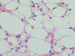 *Liposarcoma
*scalloped nucleus (LIPOBLAST) compressed by multiple little fat globs