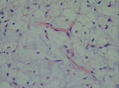 Myxoid liposarcoma
Chicken wire vascular pattern
Note lipoblast on left center