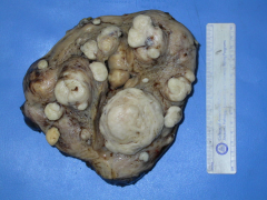 -Leiomyoma in the uterus
-tan-white fibroids
-whorled pattern