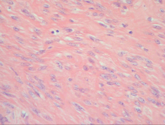 high power of Leiomyoma
-rounded nuclei
-kind of bland looking
