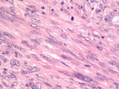 Leiomyosarcoma
mitotic figure
elongated nucleoli