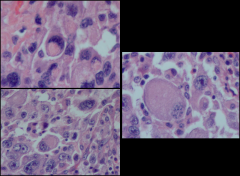 Rhabdomyosarcoma
-rhabdomyoblasts full of thick/thin filaments