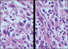 Rhabdomyosarcoma
-rhabdomyoblasts full of thick/thin filaments
-"strap cells" are elongated rhabdomyoblasts