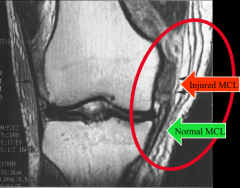 Extraarticular ligament
Excellent blood supply for healing
Majority treated non-operatively
