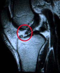 *Torn ligament does not spontaneously heal
*Unable to form fibrin clot, support humeral response, ligament ends retract
*Requires replacement to restore ligament function (if symptomatic)

pic is ACL; can't heal on its own