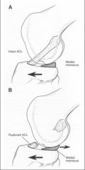 *Joint stability
*Wedge shape= chock block
*Increased MM stress with ACL removal/tear (increased MM tears with chronic ACL tear)
*Increased AP translation with medial menisectomy, ACL tear