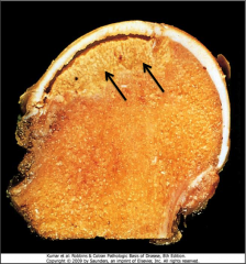 Femoral head with avascular necrosis (osteonecrosis). Note subchondral wedge of necrotic yellow tissue (arrows).