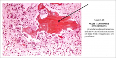Acute osteomyelitis
Note giant cells, neutrophils