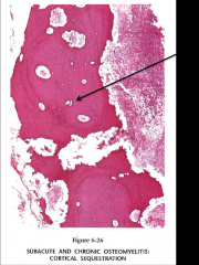 SUBACUTE AND CHRONIC OSTEOMYELITIS
arrow points to necrotic bone