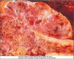 Conventional Chondrosarcoma

Intramedullary tumor growing through the cortex to form a soft tissue mass