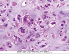 Conventional Chondrosarcoma

Anaplastic chondrocytes