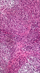 fibrosarcoma- herringbone pattern
