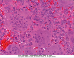 Giant Cell Tumor
Aka Osteoclastoma
“Benign” tumor of midlife
Large red-brown tumors