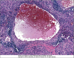 Aneurysmal Bone Cyst

Blood-filled central space. Wall contains proliferating fibroblasts, osteoclast-like giant cells and reactive woven bone.