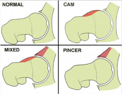 CAM lesion--bone spur becoming convex