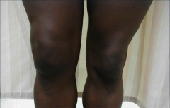 knee effusion on right side