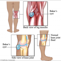 don't treat the cyst itself usually
it's a response to arthritis, usually