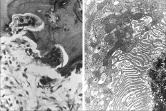 left: osteoclasts
right: lysosymes with acid phosphatase eats away bone in bone remodeling