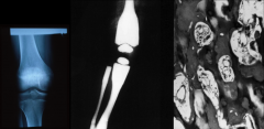 Osteopetrosis
*erlenmeyer flask shape in middle pic