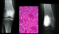 Giant Cell Tumor--Benign bone tumor
*overactive OCs; treat with "bone cement"