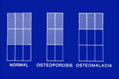 osteoporosis= less bone mass
osteomalacia- same mass, lack of calcium