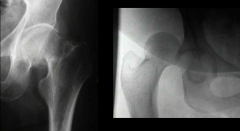 hip injuries
right--dislocation; sequelae can be blood supply problems like AVN (~15% of pts get it)