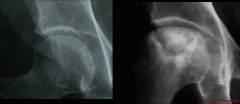 right- subchondral fracture (dead bone beneath bone surface)