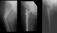 Repairs of Subtrochanteric hip fractures