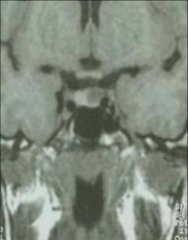 *Pituitary Incidentaloma
*About 5% of pts who get an MRI will have these
*usually no clinical significance