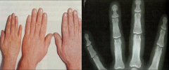 L: Acromegalic hands

R: Distal tufting of the terminal phalanges in acromegaly
