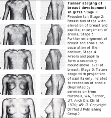 1: Pre-pubertal
2: Breast bud
3: Further enlargement
4: Areola and papilla  -  secondary mound
5: Adult