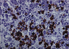 IHC stain for GH in the pituitary.