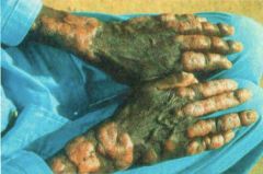lesions of a leper