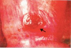 painless chancre in 1˚ syphilis (treponema pallidum).