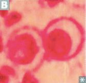 Blastomycosis-- a systemic mycosis.
States east of Mississippi River and Central America. 

Causes inflammatory lung disease and can disseminate to skin and bone. Forms granulomatous nodules.
Broad-base budding (same size as RBC)

*Blasto bu...