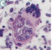 Coccidioidomycosis-- a systemic mycosis.
Southwestern United States, California. Causes
pneumonia and meningitis; can disseminate to bone and skin. 

Case rate goes up after earthquakes (spores in dust are thrown up in the air and become spher...