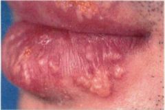 Herpes labialis. Grouped and confluent vesicles with an erythematous rim.