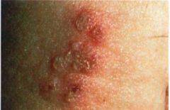Herpes genitalis. Ulcerating vesicles associated with HSV-2 and less frequently HSV-1.
