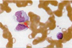 Atypical lymphocytes. Seen with EBV infection. Note "hugging" of RBCs (arrow)