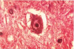 negri body--a cytoplasmic inclusion in neurons infected by rabies virus; found in purkinje cells of cerebellum.
