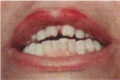 Hutchinson's teeth. Note the centrally notched, widely spaced central incisors. A neonatal manifestation of syphilis.