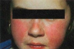 Erythema infectiosum. Slapped cheek rash of parvovirus B19.