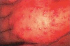 Hand-foot-mouth disease. A result of Coxsackievirus type A.