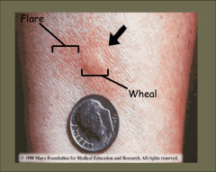 -Wheal and flare caused by subcutaneous intake of allergen.