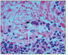 -Herpesvirus in an AIDS patient.
-Note multinucleated giant cell with intranuclear inclusion bodies; derived from monocyte lineage --> a marker of immunocompromise.