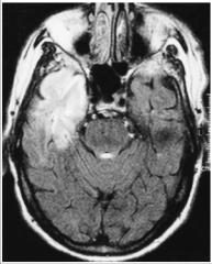 -HSV encephalitis with temporal lobe necrosis.
-Pt did well after anti-viral treatment