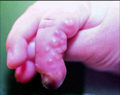-Herpetic whitlow - HSV infection of the finger, a complication of primary oral or genital herpes by inoculation of the virus through a break in the skin.

-Infection is in the nerve! Amputation wouldn't fix this.
