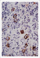 -Expression of Latent Membrane Protein 2 by Reed-Sternberg Cells.
-This is latent EBV in a Hodgkin's lymphoma patient.