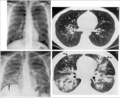 -Pulmonary KS
-Note mass lesions that are invading bronchioles and vasculature around lung